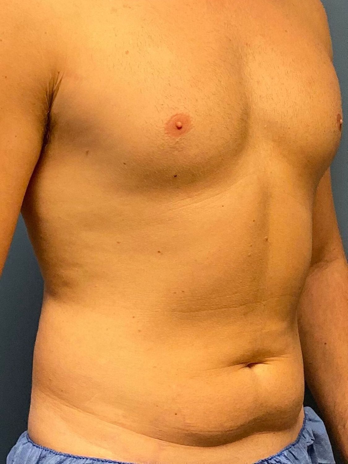 Abdominoplasty before and after - before