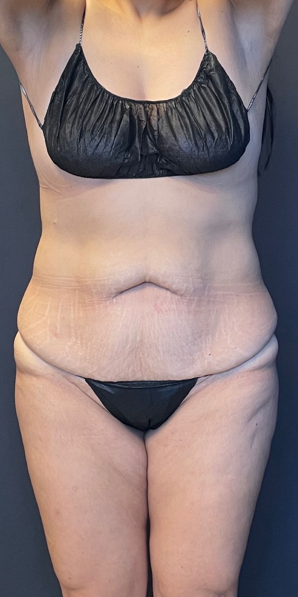 Abdominoplasty before and after - before