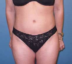 Liposuction before and after - after