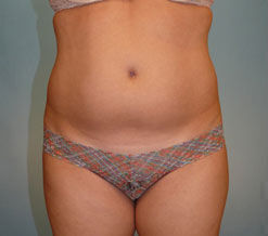 Liposuction before and after - before