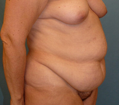 Body Contouring before and after - before