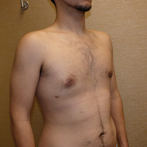 Liposuction before and after - after