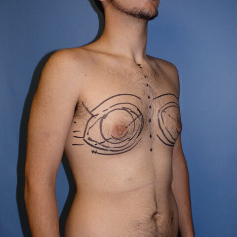 Liposuction before and after - before