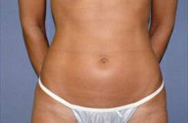 Liposuction before and after - after
