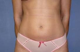 Liposuction before and after - before