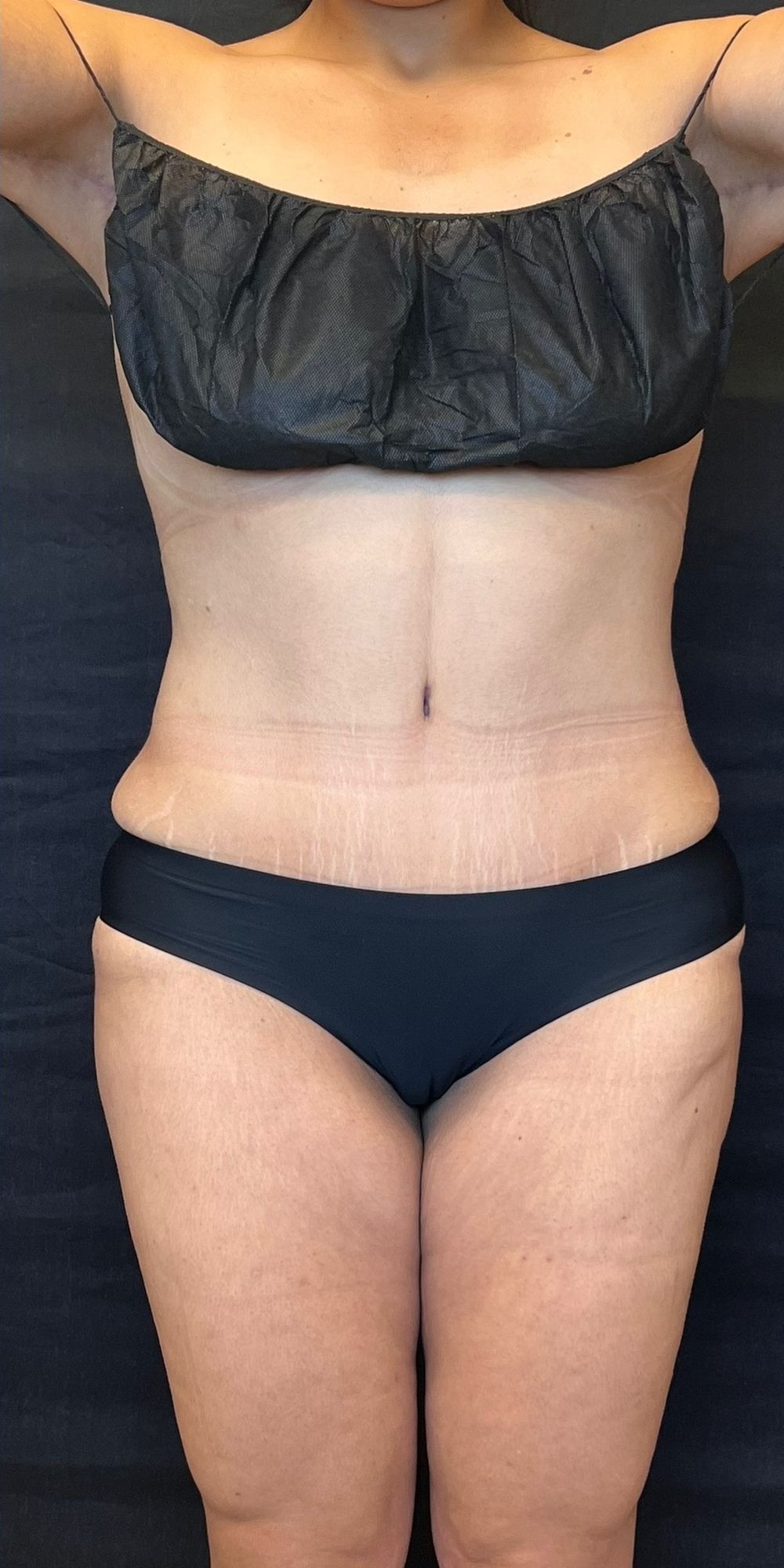 Abdominoplasty before and after - after