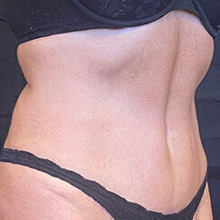 Abdominoplasty before and after - after