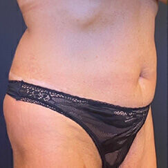 Abdominoplasty before and after - before