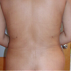 Liposuction before and after - after