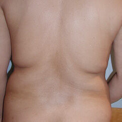 Liposuction before and after - before