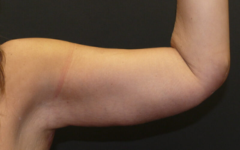 Brachioplasty before and after - after