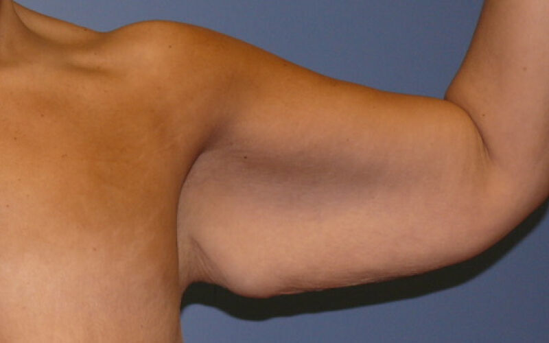 Brachioplasty before and after - before