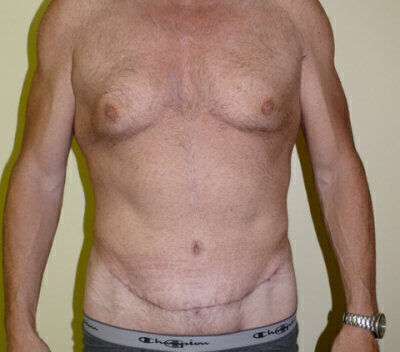 Body Contouring before and after - after