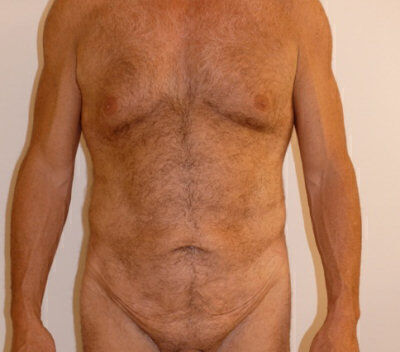 Body Contouring before and after - before