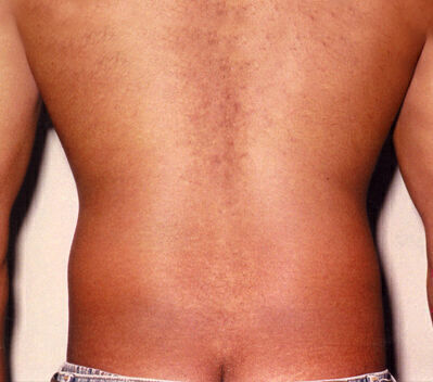 Liposuction before and after - after