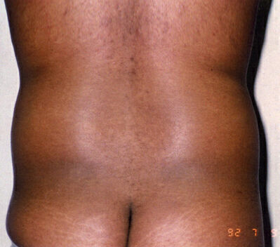 Liposuction before and after - before