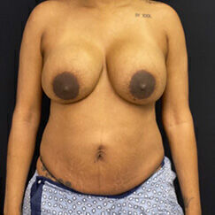 Abdominoplasty before and after - before