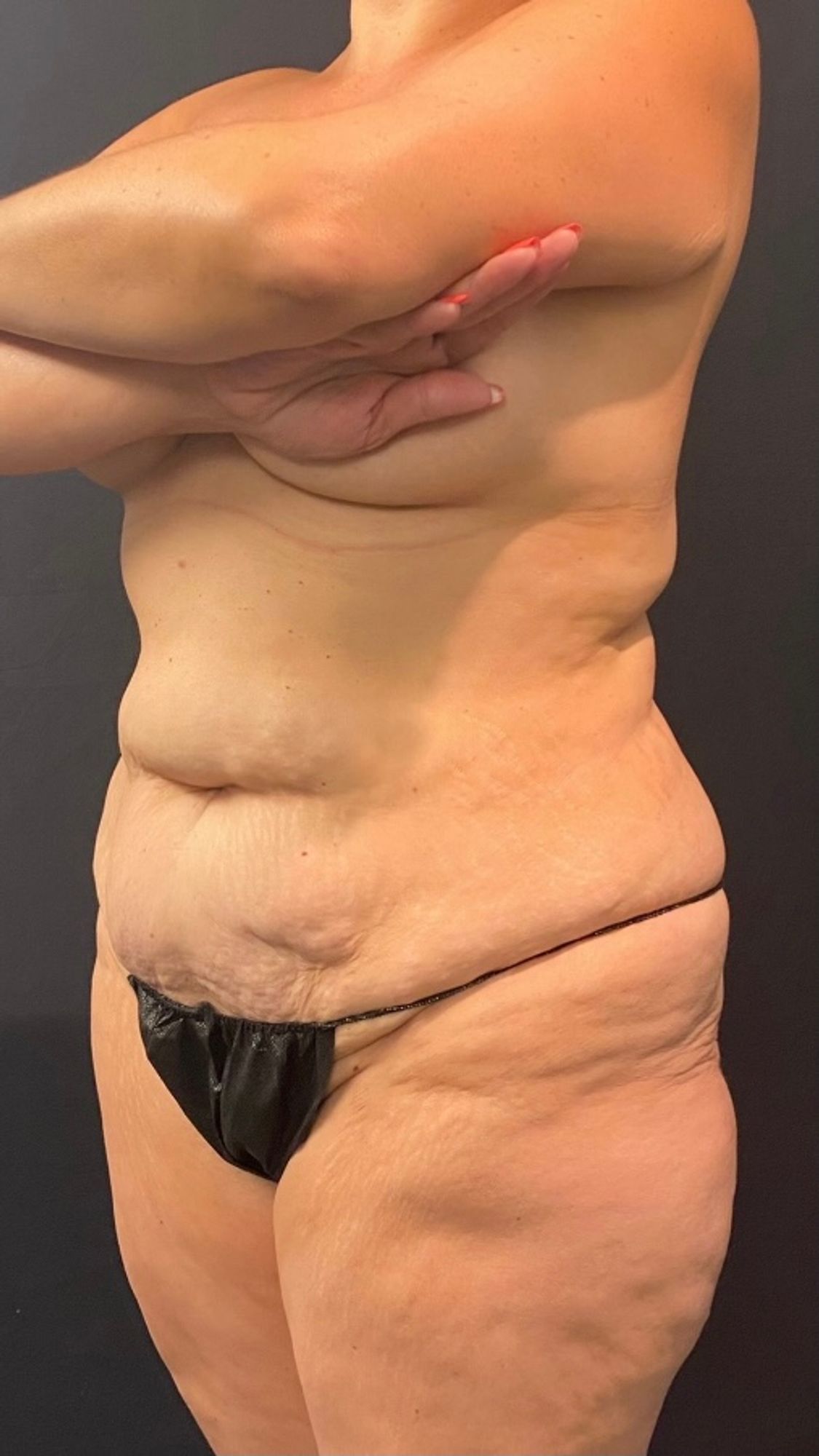 Liposuction before and after - before