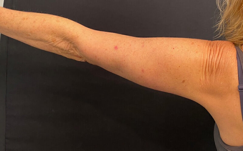 Brachioplasty before and after - after
