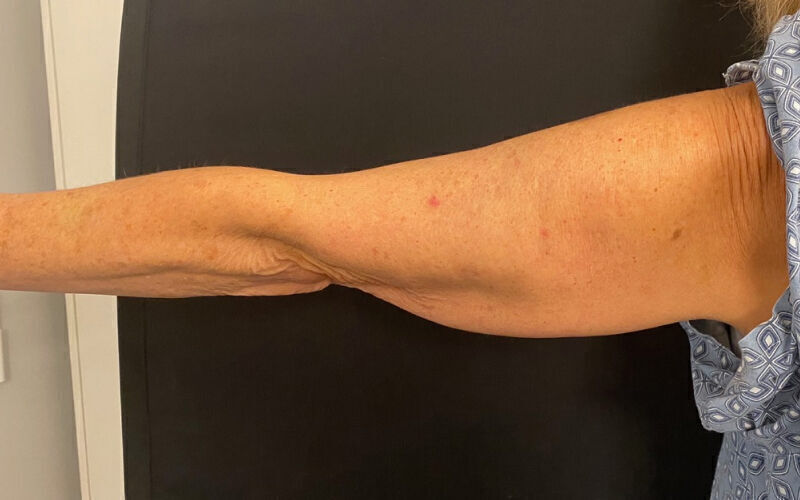 Brachioplasty before and after - before