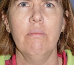 Liposuction before and after - before
