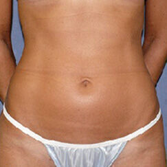 Liposuction before and after - after