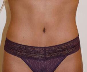 Body Contouring before and after - after