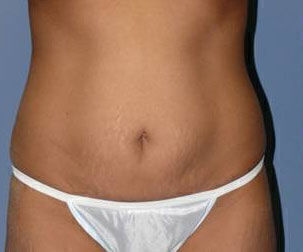 Body Contouring before and after - before