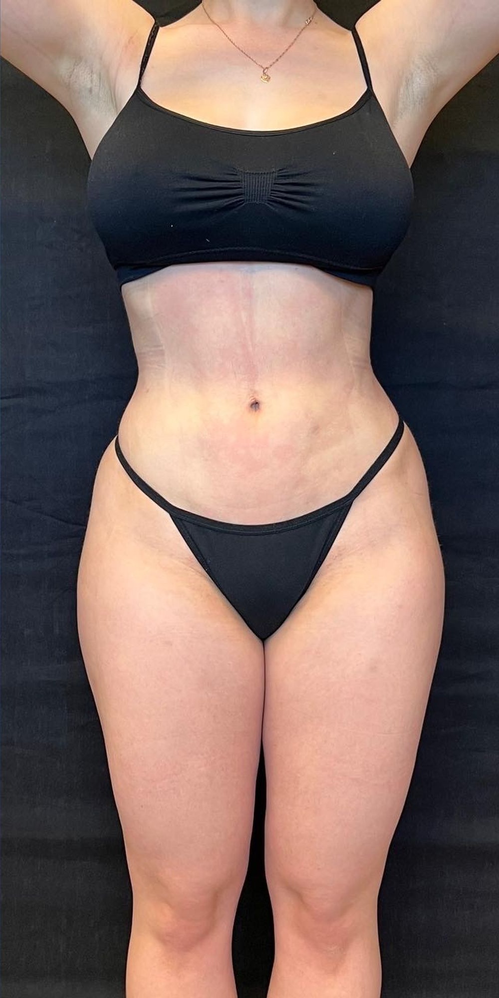 Brazilian Butt Lift before and after - after
