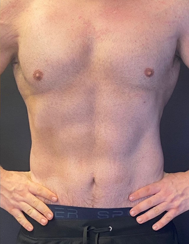 Liposuction before and after - after