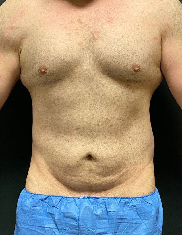 Liposuction before and after - before