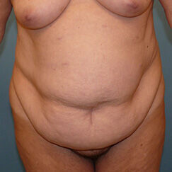 Abdominoplasty before and after - before