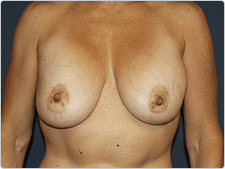 Breast Revision before and after - before
