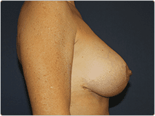 Breast Revision before and after - after