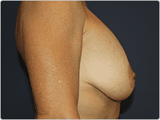 Breast Revision before and after - before
