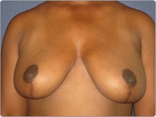 Breast Reduction before and after - after
