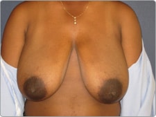 Breast Reduction before and after - before