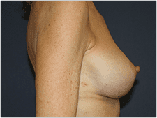 Breast Implant Revision before and after - after