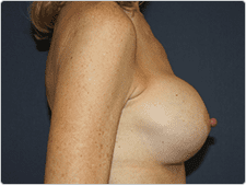 Breast Implant Revision before and after - before
