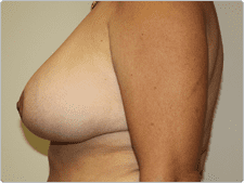 Breast Reduction before and after - after