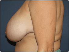Breast Reduction before and after - before