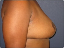 Breast Reduction before and after - after