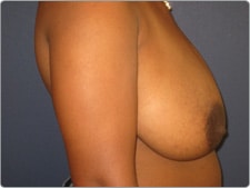Breast Reduction before and after - before