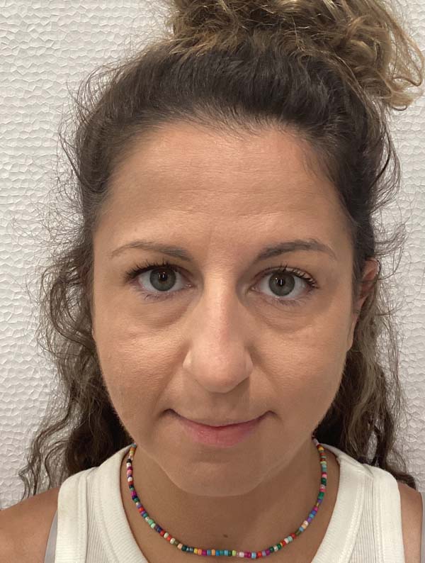 Rhinoplasty before and after - before