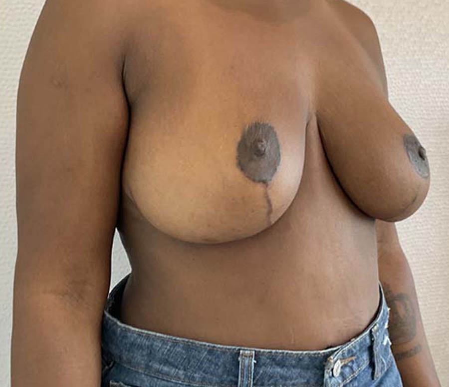 Breast Reduction before and after - after