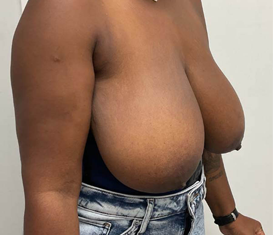 Breast Reduction before and after - before