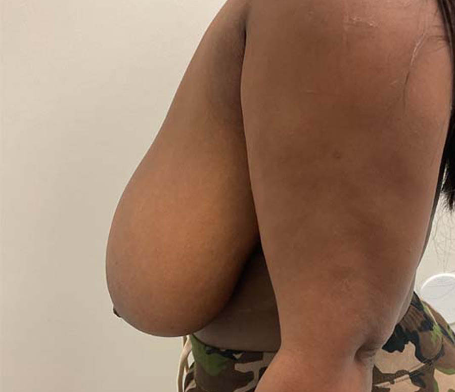 Breast Reduction before and after - before