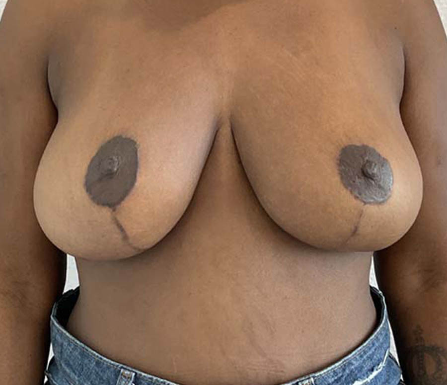 Breast Reduction before and after - after