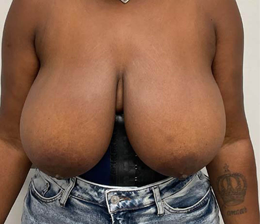 Breast Reduction before and after - before