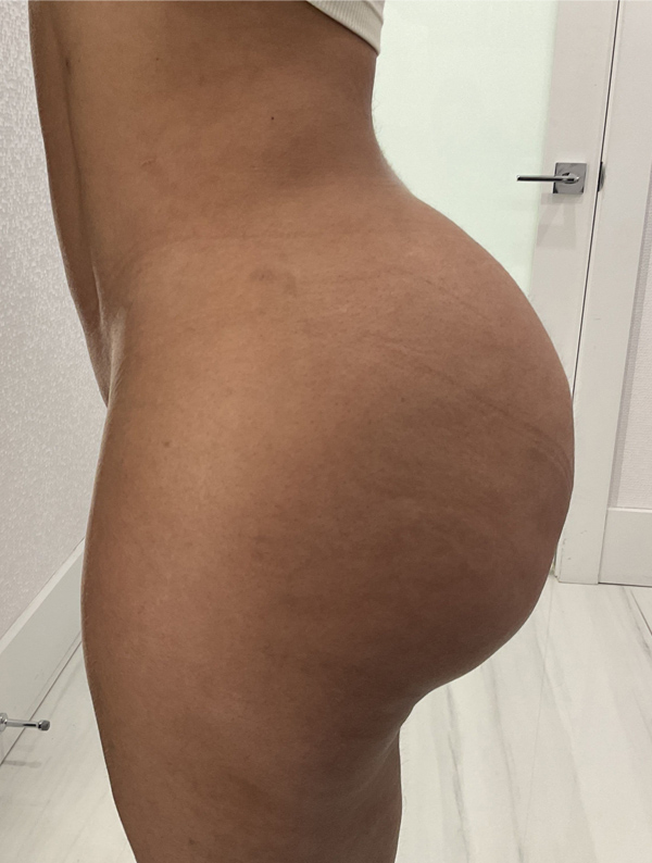 Procedure before and after - after